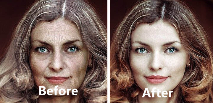 melasma before Treatment in Ranchi
