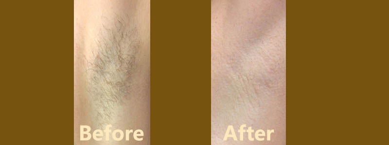 Laser hair removal Treatment in Ranchi