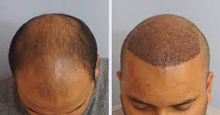 permanent Hair transplant Treatment in Ranchi