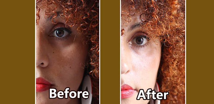 melasma before Treatment in Ranchi