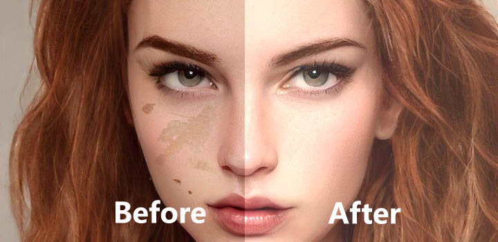 Laser hair removal Treatment in Ranchi