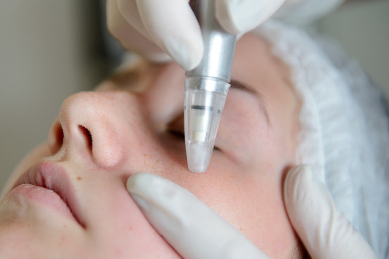 microdermabrasion Treatment in Ranchi