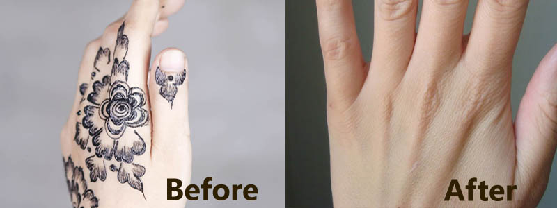 permanent tattoo removal Treatment in Ranchi